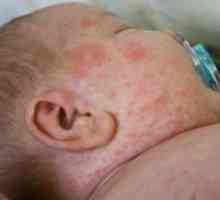 Алергичен обрив при дете