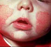 Алергия при кърмачета - какво нещастие?