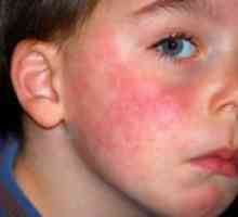 Алергии при децата - как да се лекува?