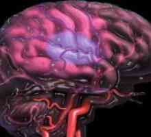 Мозъчна атеросклероза - Симптоми