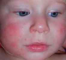 Атопичен дерматит при деца - Лечение