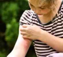 Как за лечение на ухапване от комар дете?