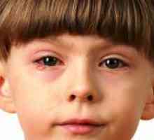 На изплакнете очите конюнктивит при деца?