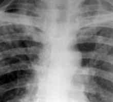 Разпространена туберкулоза