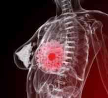 Доброкачествена тумор на гърдата - Лечение