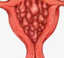 Хиперплазия на ендометриума - какво е това?