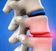 Гръбначния херния - симптоми и лечение