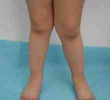 Х-образна крака при децата