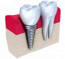 Зъбните импланти - противопоказания и възможни усложнения