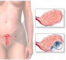 Endometrioid киста на яйчниците - Лечение