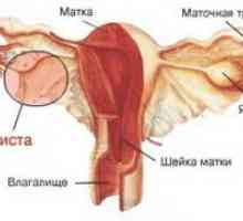 Корпус на матката Ендометриозата