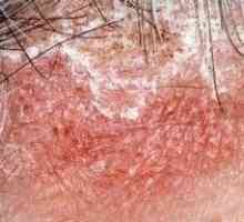 Себорея на кожата на главата - най-ефективните лечения