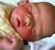 Как за лечение на диатеза по бузите при бебетата?