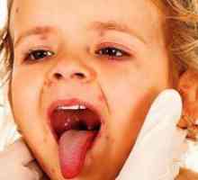 Как за лечение на херпес на устата в гърлото на детето?
