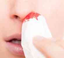 Как да спрем кръвотечение от носа?