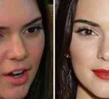 Kendall Jenner преди и след пластмаса