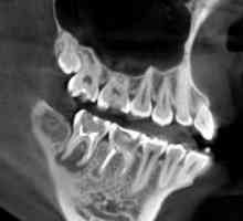 Компютърна томография зъби