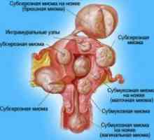 Миома на матката - лечение на народната медицина