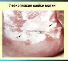 Маточната шийка левкоплакия - Симптоми