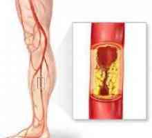 Нарушение на кръвообращението на долните крайници кръв - Симптоми