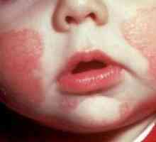 Атопичен дерматит при деца