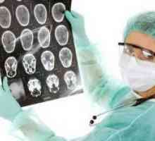 Мозъчен тумор - симптоми в ранните етапи