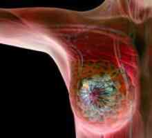Хранене при рак на гърдата