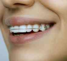 Плочки за подравняване зъби