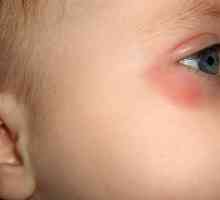 Защо едно дете може да бъде червено под очите