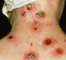 Симптомите на сифилис при жените