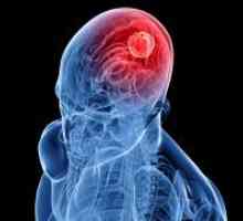 Brain Cancer - Симптоми