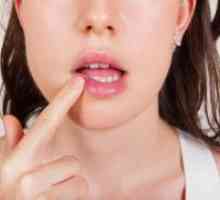 Рак на устните - симптоми, ранни признаци