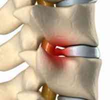 Рак на гръбначния стълб - Симптоми и признаци