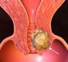 Ракът на маточната шийка - причината за