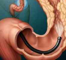 Рак на дебелото черво - симптоми