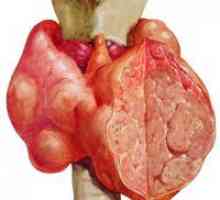 Нодуларна гуша на щитовидната жлеза - симптоми и лечение