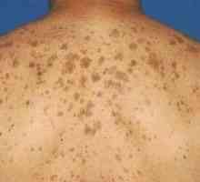 Видове пигментни петна по кожата и тяхното лечение