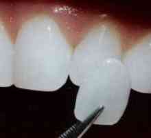 Фасетите на зъбите