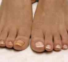 Жълтите нокти на краката