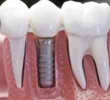 Зъбните импланти - "за" и "против"