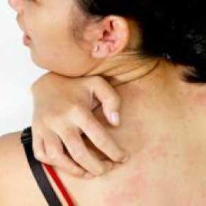 Алергии към прах