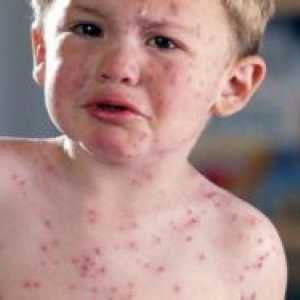 Алергия към сладко при дете