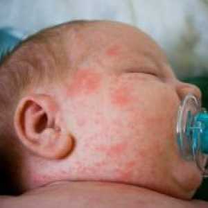 Алергии при бебетата