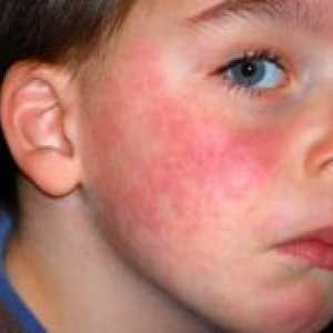 Алергии при децата - как да се лекува?