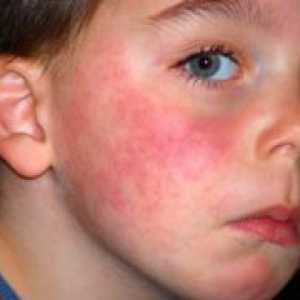 Симптомите на алергии при децата