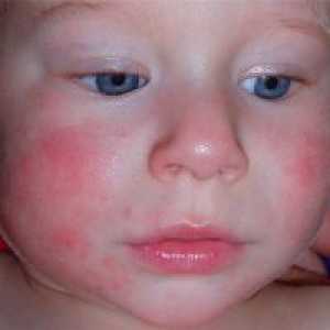 Атопичен дерматит при деца - Лечение