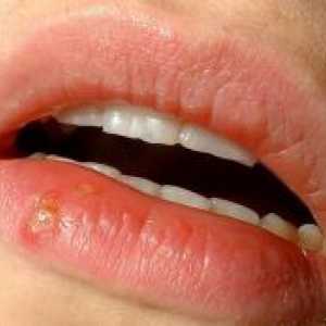 Рана на устната