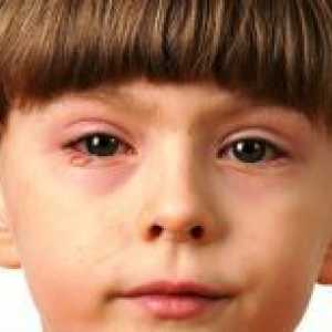 На изплакнете очите конюнктивит при деца?