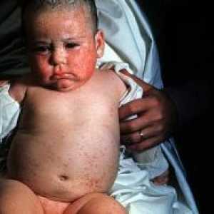 Цитомегаловирус инфекция при деца - Лечение