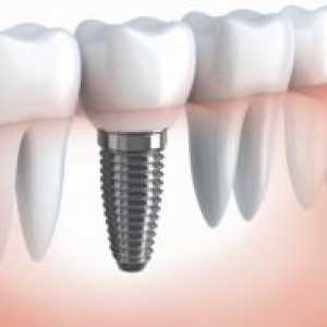 Зъбните импланти